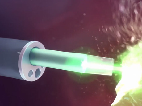 Enucleation laser Holep